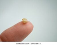Närbild på en liten gulvit tonsillsten som vilar på en fingertopp.