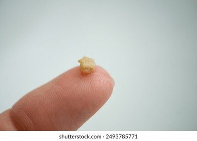 Närbild på en liten gulvit tonsillsten som vilar på en fingertopp.